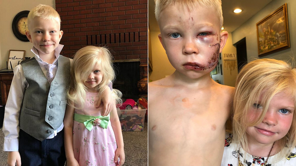 ABD’de, dört yaşındaki kız kardeşini köpek saldırısından kurtarmak için araya giren ve yüzüne 90'dan fazla dikiş atılan altı yaşındaki Bridger Walker günün kahramanı oldu. - Sputnik Türkiye