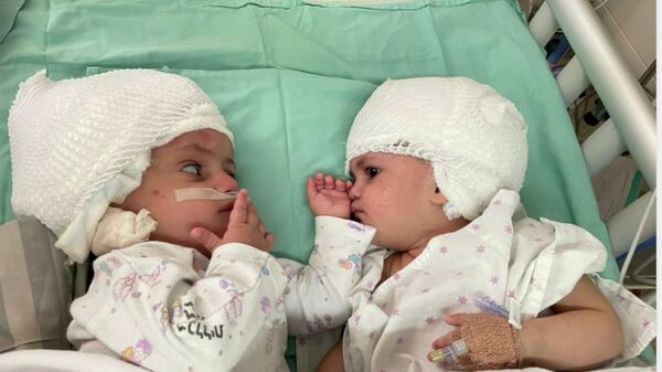 Kafaları yapışık doğan ikizler 12 saatlik ameliyatla ayrıldı - Sputnik Türkiye