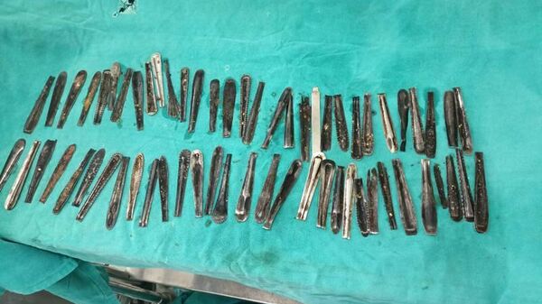 Hindistan'da hastaneye giden adamın midesinden 60'dan fazla metal kaşık - Sputnik Türkiye