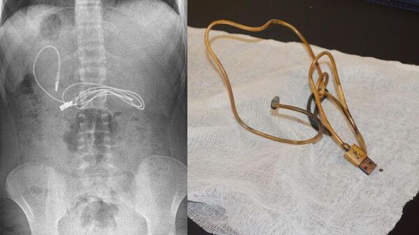 15 yaşındaki çocuğun midesinden 1 metrelik şarj kablosu ve toka çıktı - Sputnik Türkiye