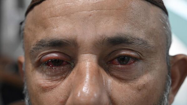 Pakistan'da bulaşıcı 'kırmızı göz' hastalığı - Sputnik Türkiye