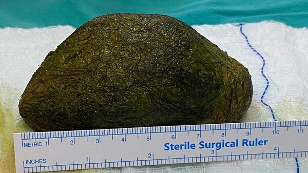 Karın ağrısı şikayetiyle hastaneye başvurdu, midesinden 2 kilo saç çıktı - Sputnik Türkiye