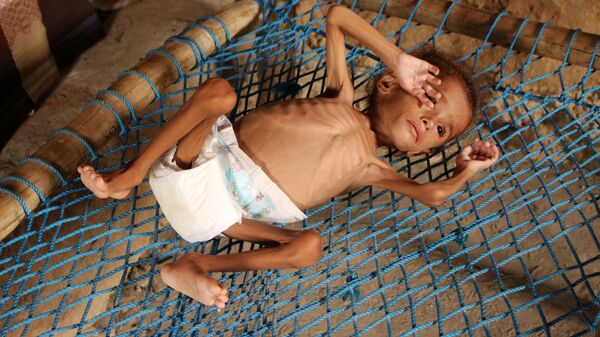 Yemen'de açlık ve yetersiz beslenme - Sputnik Türkiye