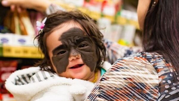 Batman maskesini andıran bir doğum lekesine sahip minik kızın tedavisi Rusya’da başladı - Sputnik Türkiye