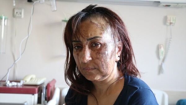 Boşanma davası açtığı eşinin kezzaplı saldırısına uğradı  - Sputnik Türkiye